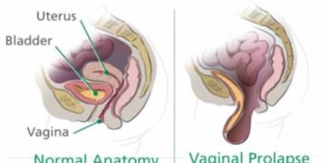 Vaginal Prolapse Kelainan Organ Panggul Wanita Harus Tahu